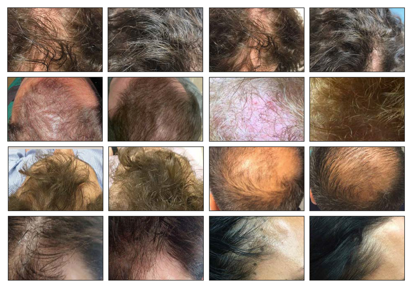 dr cyj filler cheveux